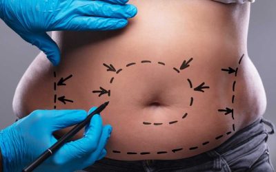 Understanding Liposuction: The Ultimate Guide to This Popular Body Contouring Procedure