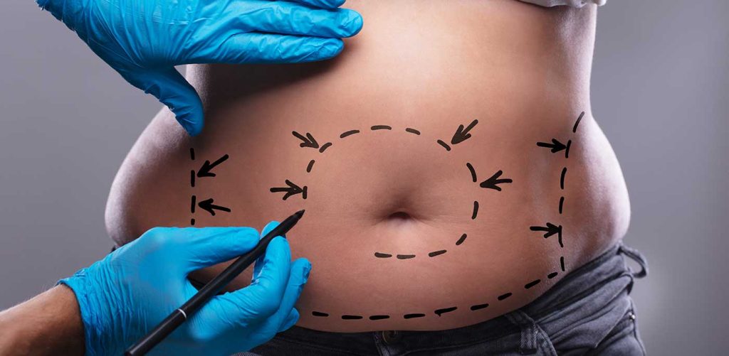 Understanding Liposuction: The Ultimate Guide to This Popular Body Contouring Procedure