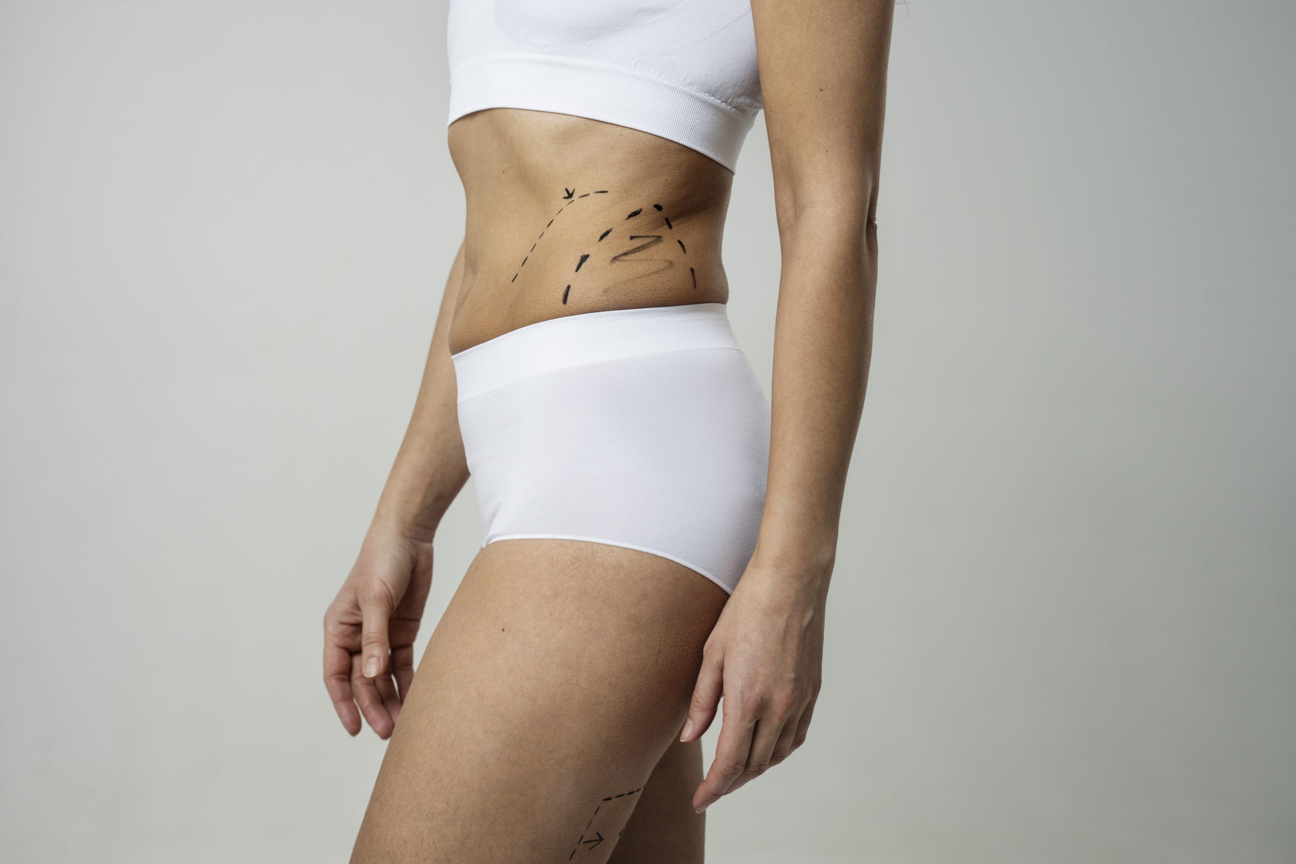360 Liposuction in Kenya