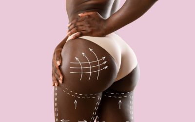 Brazilian Butt Lift in Kenya