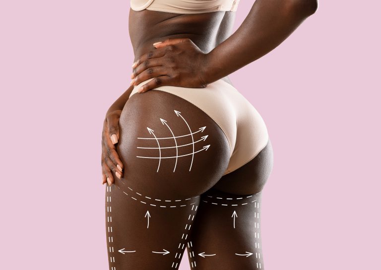 Brazilian Butt Lift in Kenya