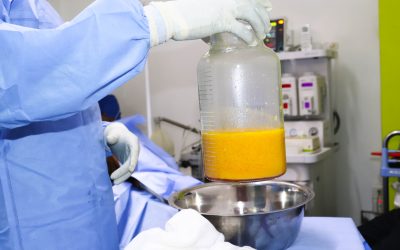 BBL Surgery in Kenya – Syn Plastics & Aesthetic Kenya