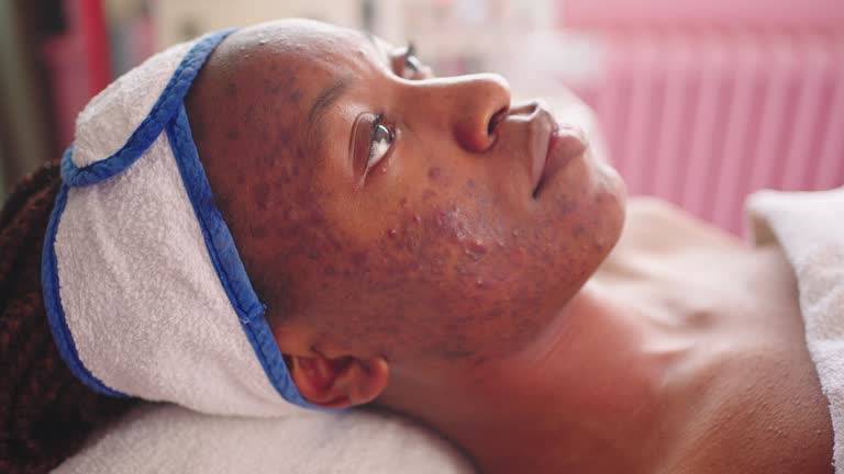 side view of ethnic young woman with acne scars on face minimal
