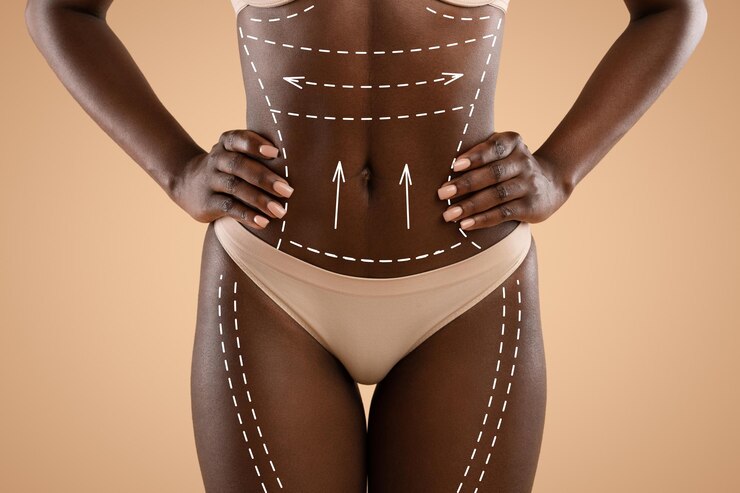 body lift kenya