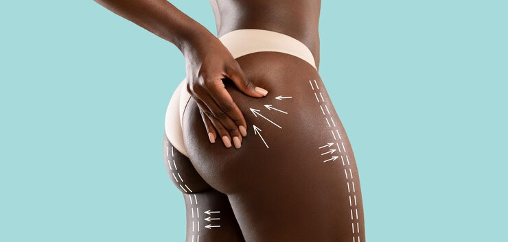 lipofilling