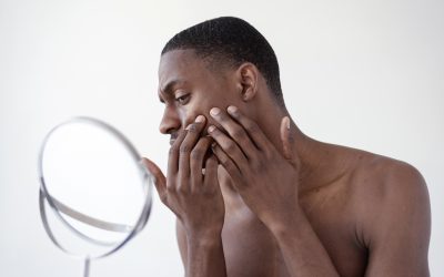 Acne Treatment in Kenya